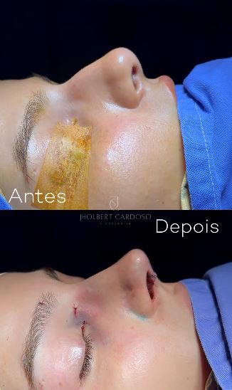 Antes e depois de rinoplastia