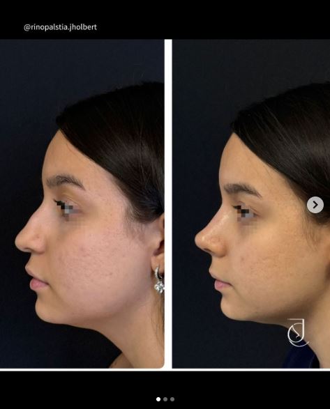 Antes e depois de rinoplastia