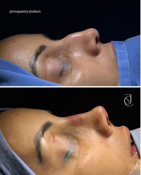 Antes e depois de rinoplastia