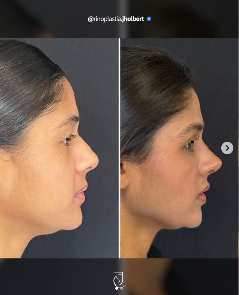 Antes e depois de rinoplastia